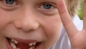 crianca-sem-dente-Bobos-sem-corte